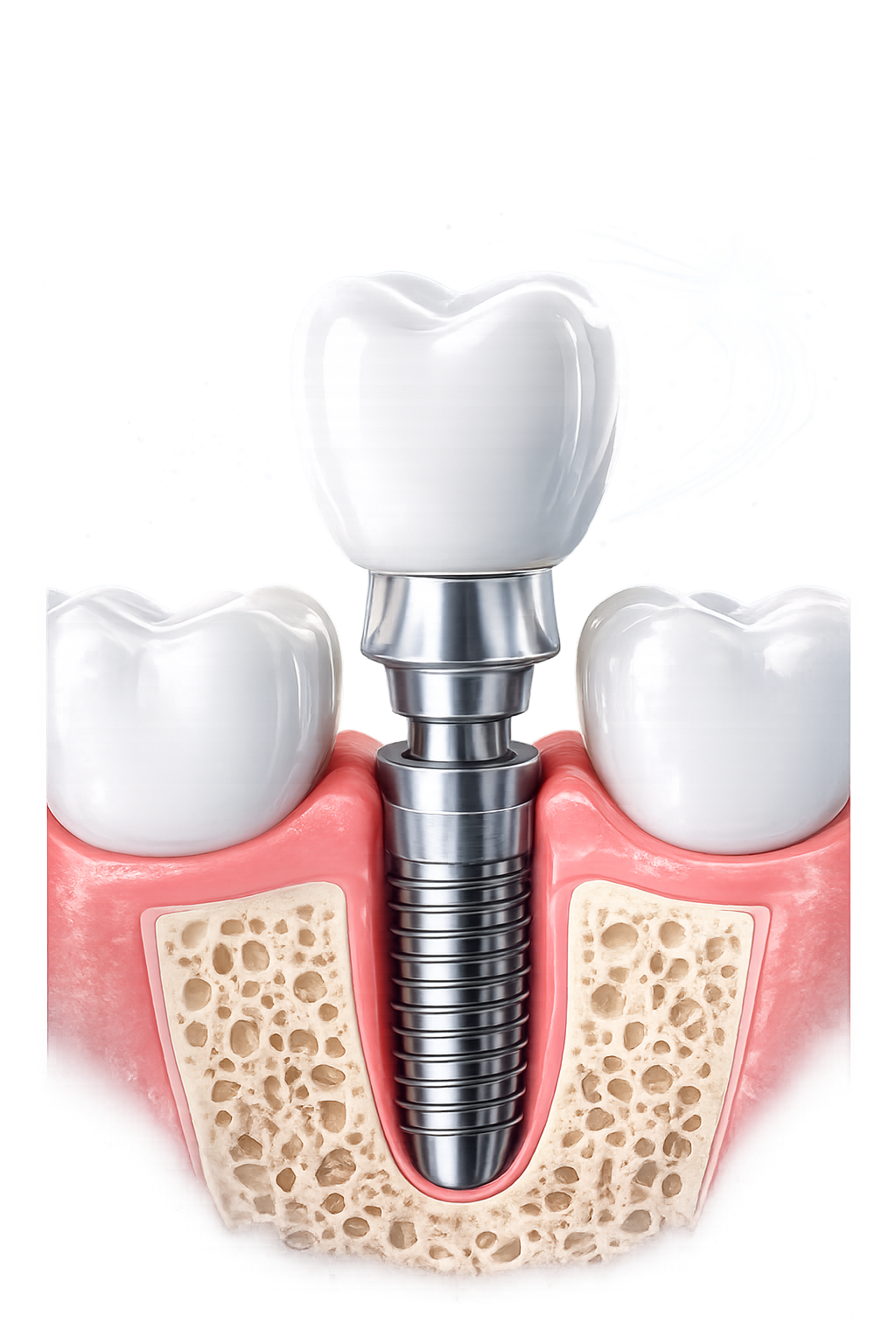 Dental implant treatment