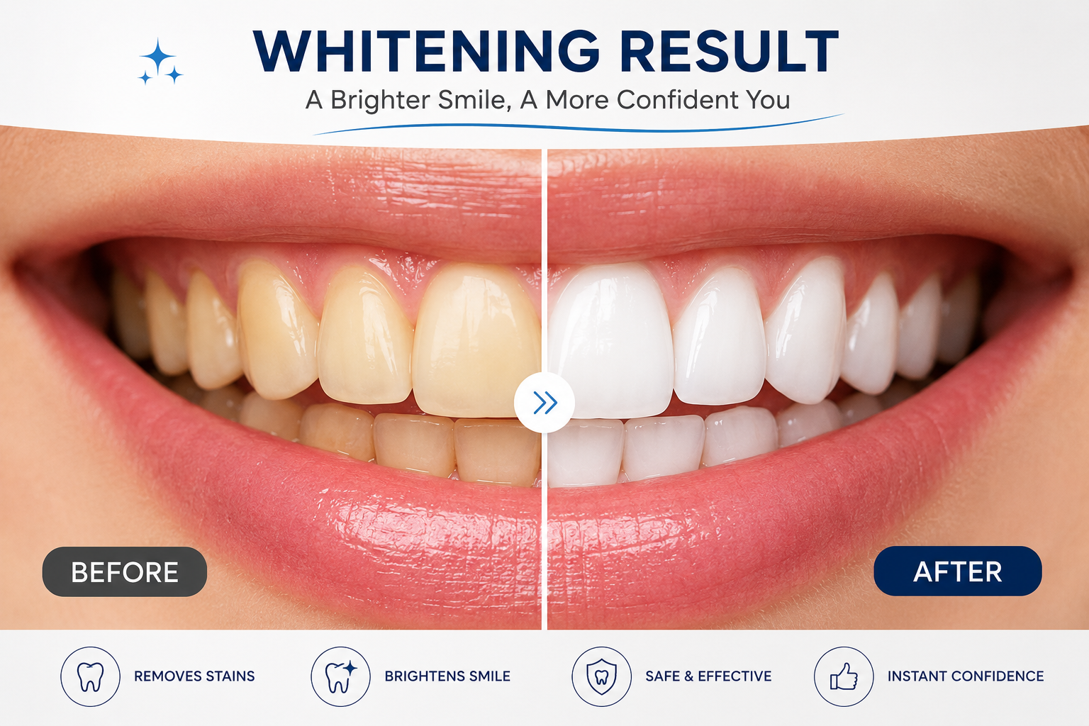 Before and after teeth whitening result